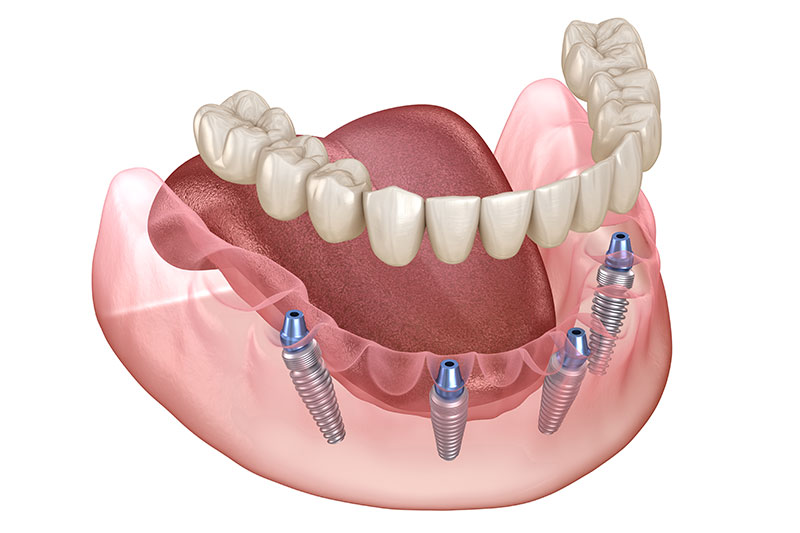 Fixed Implant Dentures in Dublin