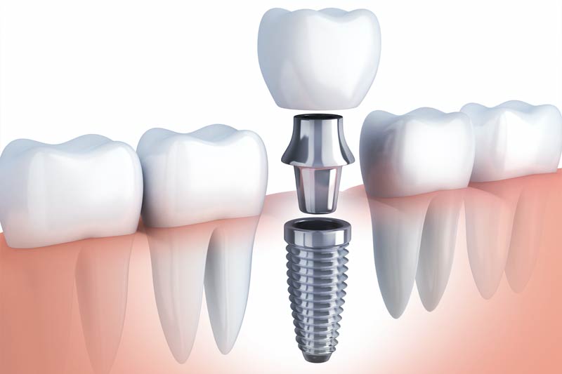 Implants Dentist in Dublin