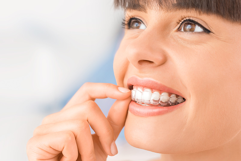 Clear Aligners in Dublin
