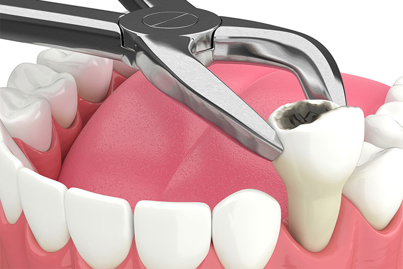 Tooth Extractions in Dublin